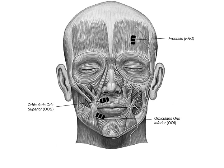Facial muscles of interest. Two speech-related labial muscles: \textit{orbicularis oris superior} (OOS) and \textit{orbicularis oris inferior} (OOI); as well as one non speech-related but sadness-related facial muscle: \textit{frontalis} (FRO).